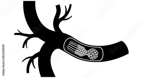 Illustration of a Blood Vessel with Stent Placement.