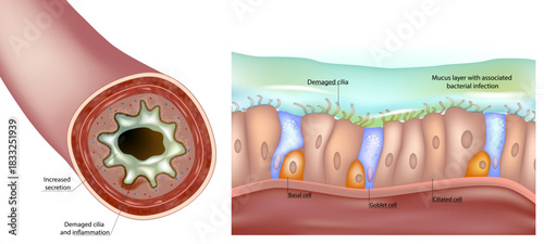 Medical illustration showing damage to the respiratory epithelium, impaired cilia, increased mucus production, airway inflammation, and bacterial infection. Cross-section of the bronchial lumen 