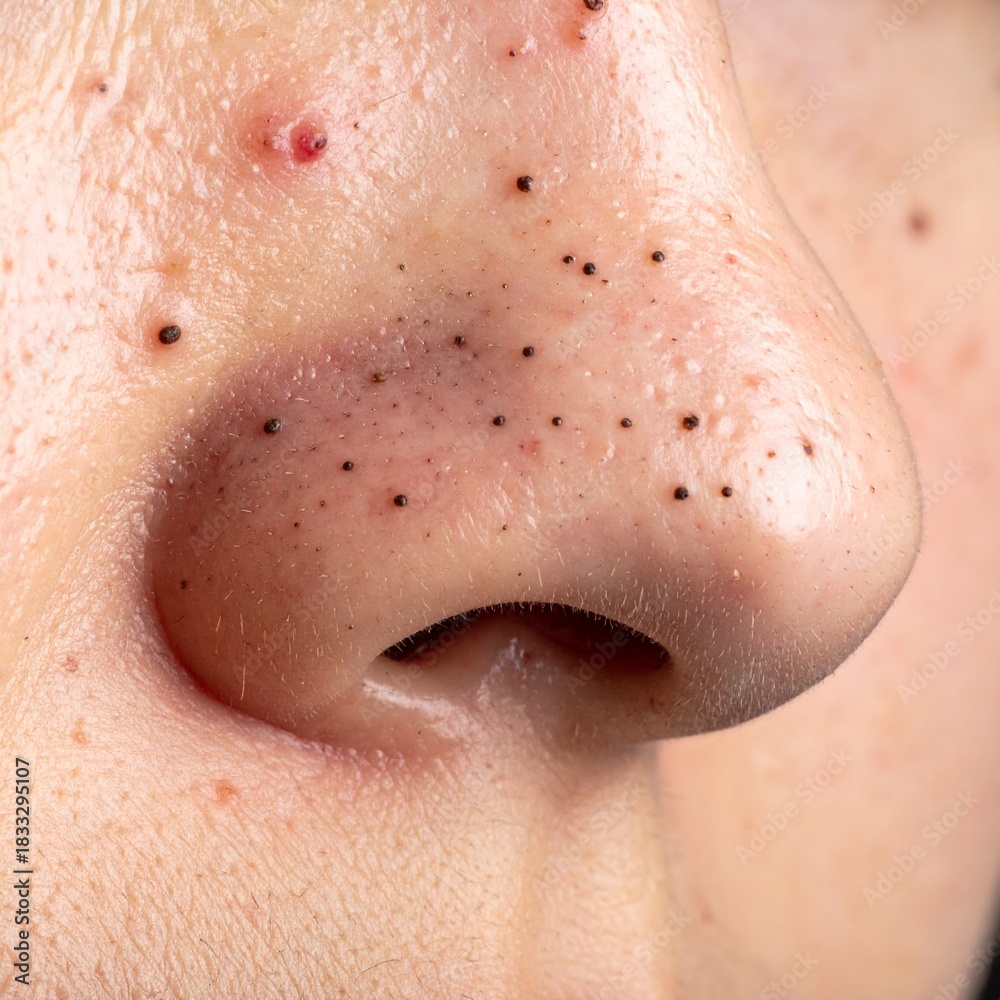 Fototapeta premium A macro, high-resolution photograph of the human nose's side profile, focusing intensely on the skin's texture, showing numerous prominent, dark, pore-clogging blackheads and minor redness.