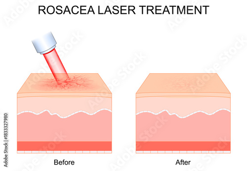 Rosacea laser treatment. Telangiectasia removal