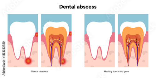 Clear, minimal medical diagram showing the basic anatomy of tooth affected by dental abscess