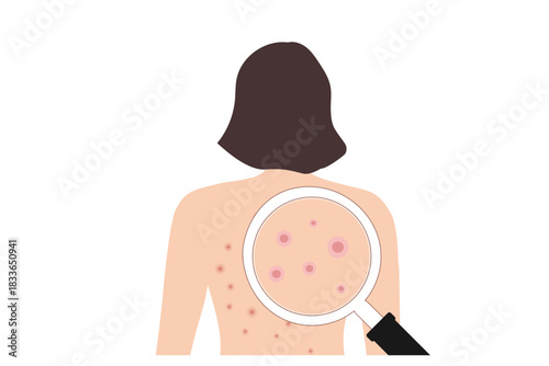 Acne on woman back. Allergy and Acne Skin Problems, Scratching her back vector illustration
