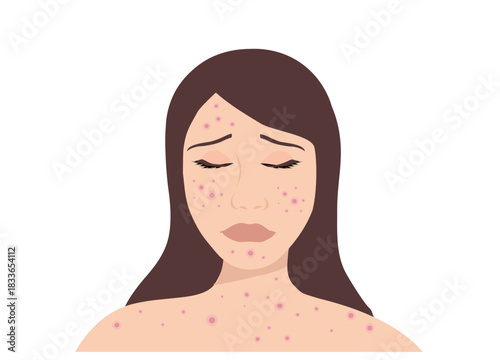 Young woman face with skin acne, pimples, blackheads vector illustration. Acne skin face problem concept