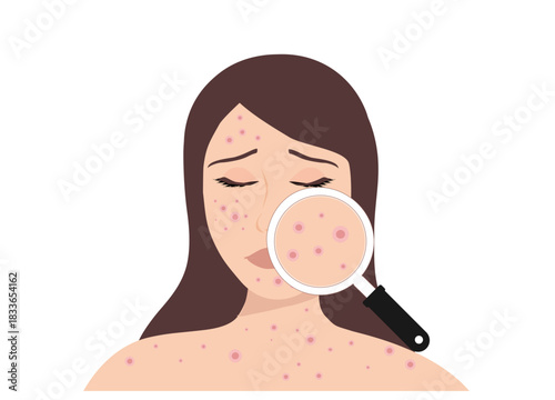  Dermatologist checking young woman face with skin acne, pimples, blackheads vector illustration. Acne skin face problem concept

