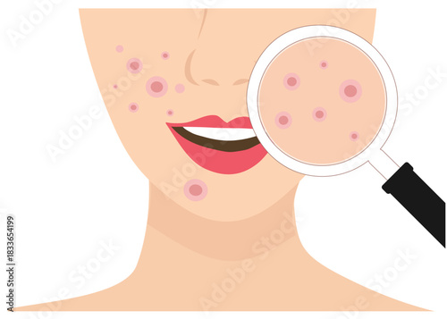 Dermatologist checking young woman face with skin acne, pimples, blackheads vector illustration. Acne skin face problem concept
