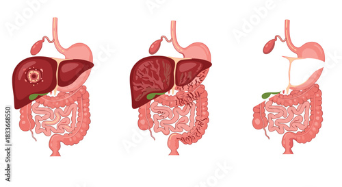 Medical infographic showing the progression of liver disease, including cancer, cirrhosis, and resulting in a partial gastrectomy.