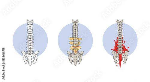 Medical illustrations comparing a normal spine with conditions like osteoporosis and ankylosing spondylitis or severe inflammation.
