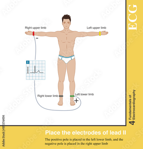 Lead Ⅱ is a standard limb lead, with the positive pole placed in the left lower limb and the negative pole placed in the right upper limb.
