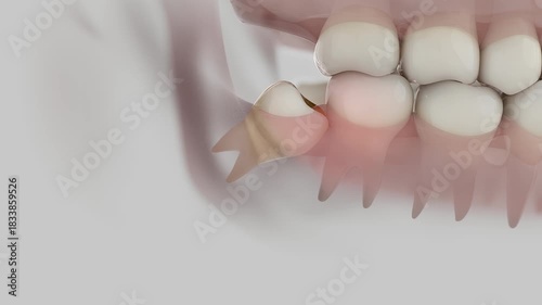 Growing Wisdom Tooth Causing Pain. 3d Animation
