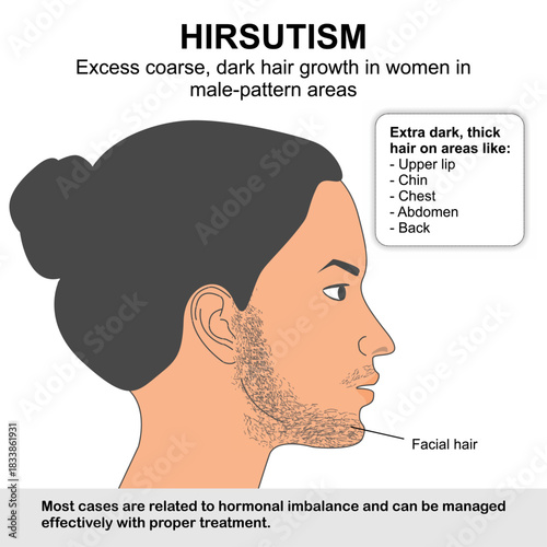 Hirsutism facial hair growth in women like men