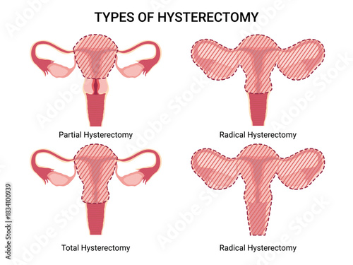 Hysterectomy, surgical removal of the uterus. Vector Medical illustration shows 4 types of hysterectomy: partial, total, radical types. Removal of fallopian tubes, ovary.
