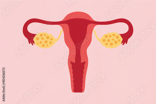 Medical Illustration of Polycystic Ovary Syndrome (PCOS) – Ovarian Cysts in the Female Reproductive System