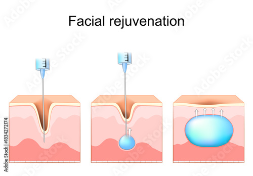 Facial rejuvenation. Anti-aging treatments. Wrinkle Before and after Dermal fillers