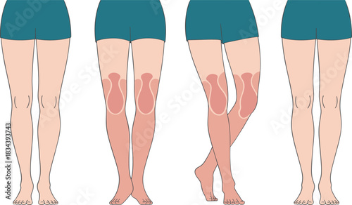 Human Leg Pain Zone Illustration Showing Front View with Highlighted Thigh and Knee Areas in Medical Vector Format