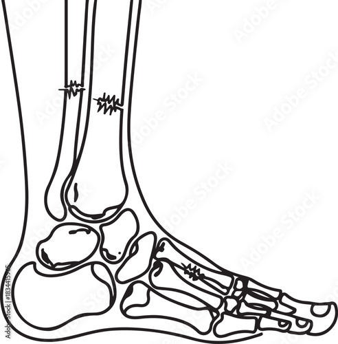 Fractures of human foot bones. Fractures in different places of the leg due to injury. Vector illustration. one line Icon drawing