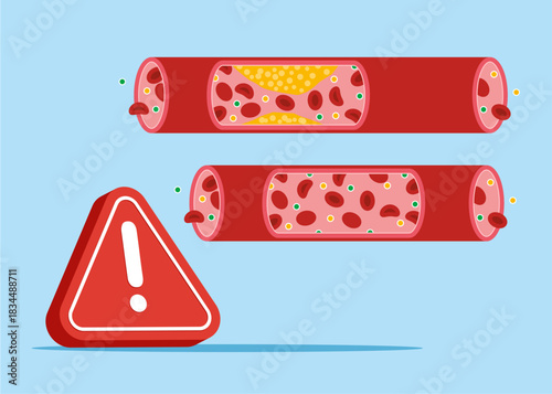 Human blood vessels with exclamation attention sign. Veins from cholesterol and blood cells clot. Cardiovascular system, cardiology, medical examination topics. Problem. Flat vector illustration