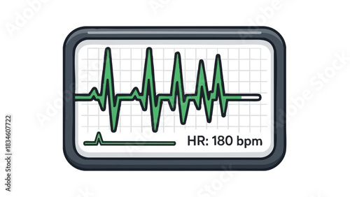 Heart monitor screen displaying arrhythmia pattern with 180 bpm  