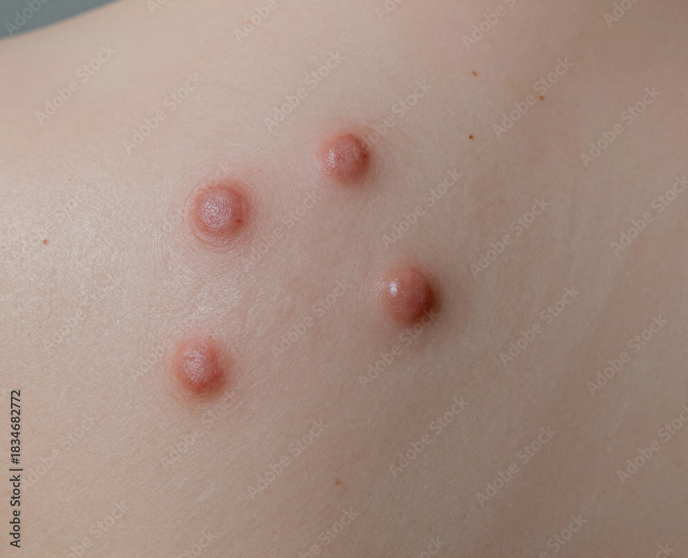 Fototapeta premium Four dome-shaped, reddish-pink papules or nodules are visible on the light-toned skin, indicating a dermatological condition.