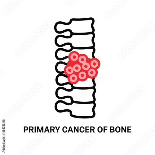 Illustration of primary bone cancer affecting the spine