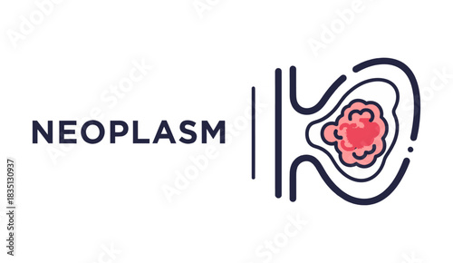 Neoplasm: Medical Vector Illustration of Abnormal Cell Growth or Tumor