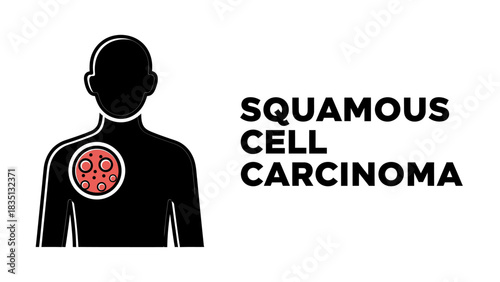 Squamous Cell Carcinoma (SCC) Vector Icon