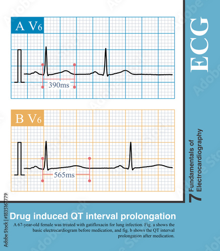 Canvastavla When the ST segment of the de Winter T wave changes from depressed to elevated, it indicates progression to acute AMI, with myocardial ischemia spreading from subendocardial to epicardial
