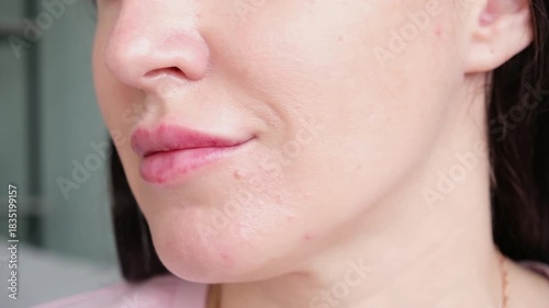 Women's lips on the second day after the introduction of hyaluronic acid, lip healing after enlargement