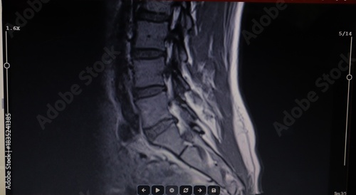 Fotografija Doctor examines an MRI scan of the lumbar spine, highlighting a mild broad-based L5-S1 disc protrusion