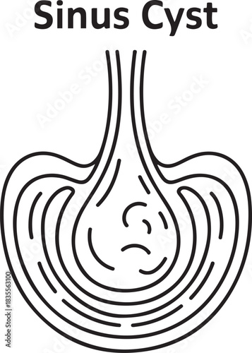Sinus cyst drawn with lines. Benign sac-like formation in the cavity of the paranasal sinus. Medical vector illustration for different uses. one line Icon drawing