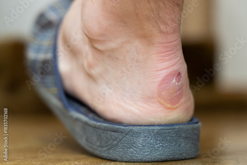 Heel blister with peeled skin close-up