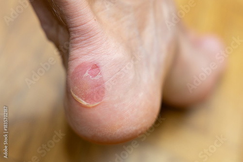 Фотография Heel blister with peeled skin close-up