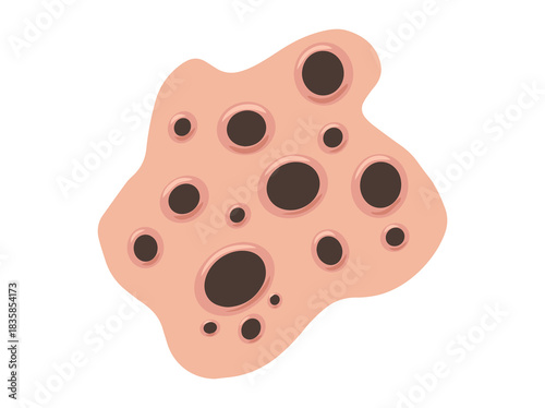 Acne Blackhead in Face Skin
