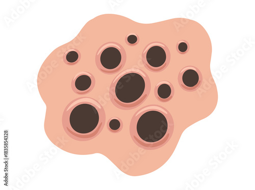 Acne Blackhead in Face Skin
