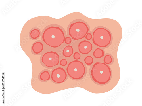 Acne Cystic in Face Skin
