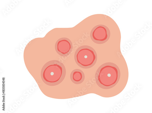 Acne Cystic in Face Skin
