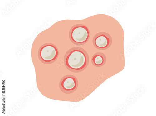 Acne Pustule in Face Skin