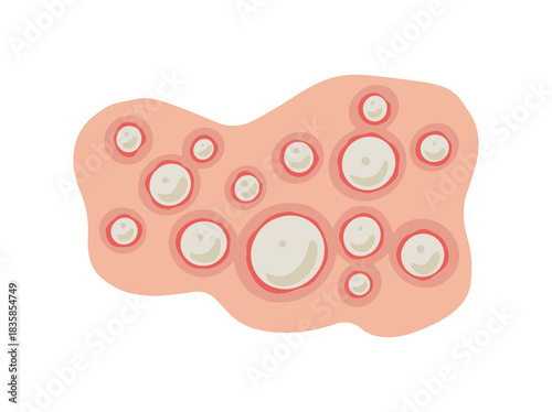 Acne Pustule in Face Skin