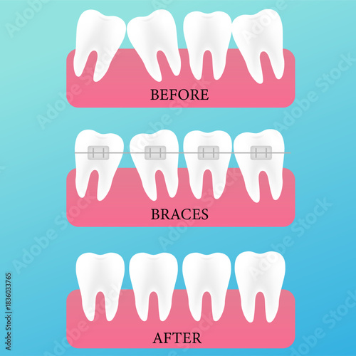 Orthodontic Progress Infographic Cartoon Sequence from Misaligned Teeth to Perfect Smile with Braces Treatment Illustration