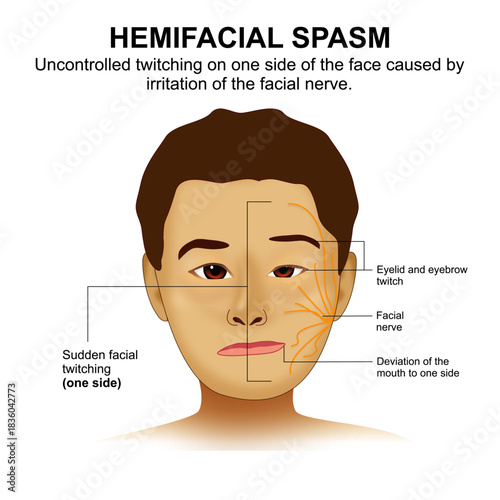 Hemifacial Spasm - Mouth pulls to one side