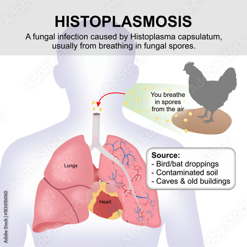 Histoplasmosis - Histoplasma capsulatum lung flashcard 