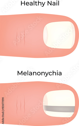 Healthy Nail vs Melanonychia A Visual Comparison