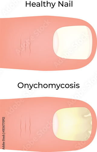 Healthy Nail vs Onychomycosis A Visual Comparison of Nail Fungus Vector Illustration