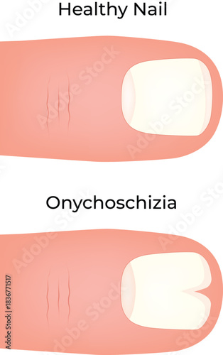 Onychoschizia Healthy Nail vs. Split Nail Condition Comparison Vector illustration