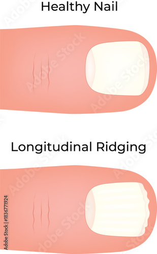 Healthy Nail vs. Longitudinal Ridging Comparison Vector Illustration