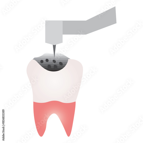 Dental Drilling Illustration