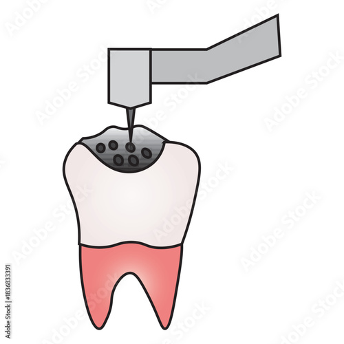 Dental Drilling Illustration