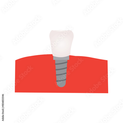 Dental Implant