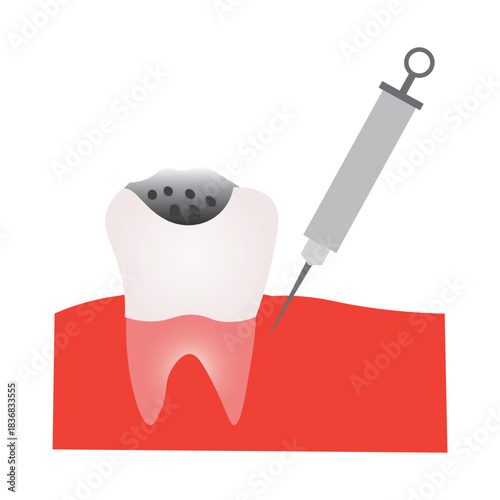 Dental Cavity Treatment with Local Anesthesia Injection