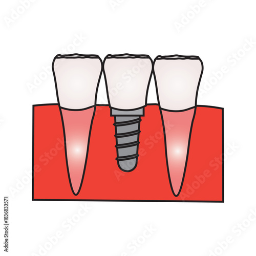 Dental Implant and Tooth Replacement