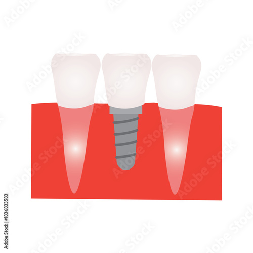 Dental Implant and Tooth Replacement
